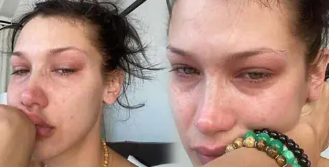 Bella Hadid'den Korkutan İtiraf: Lyme Hastalığı ile Zorlu Mücadele