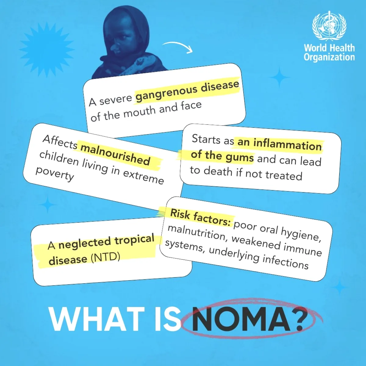 Noma Hastalığı Nedir? DSÖ'nün Resmen Tanıdığı Bu Çocuk Hastalığına Dikkat Noma Hastalığı Nedir? DSÖ'nün Resmen Tanıdığı Bu Çocuk Hastalığına Dikkat