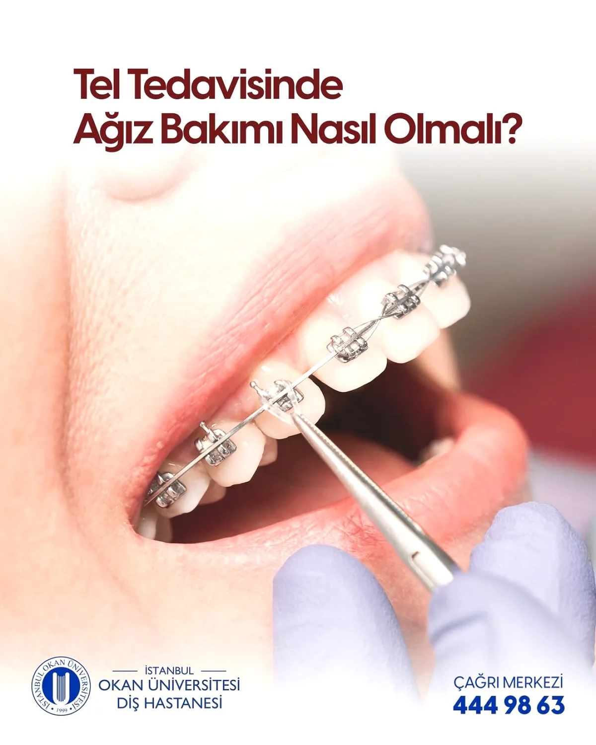 Ortodontik Tedavide Ağız Bakımı Neden Kritik? | İstanbul Okan Ortodontik Tedavide Ağız Bakımı Neden Kritik? | İstanbul Okan