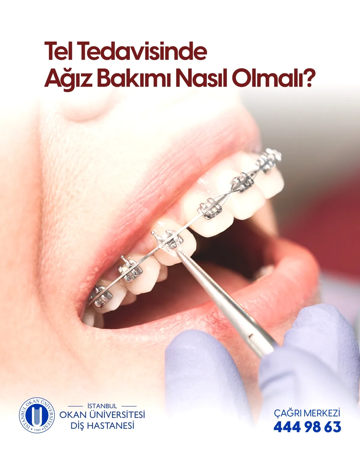Ortodontik Tedavide Ağız Bakımı: Braketlerde Plak Riski Ortodontik Tedavide Ağız Bakımı: Braketlerde Plak Riski