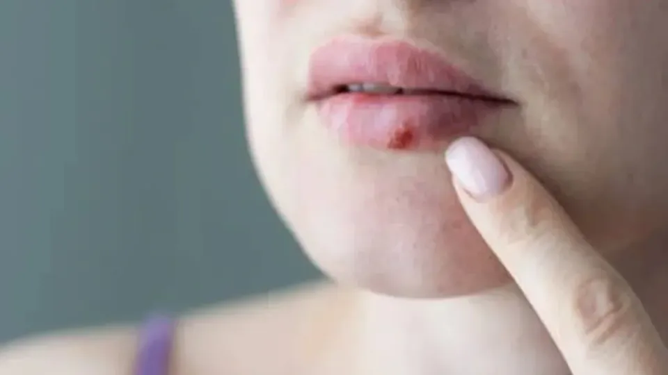 Herpes Virüsünün Gizli Tehlikesi: Sadece Uçuk mu Yoksa Beyinle Bağlantılı mı? görseli