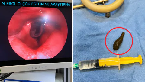 Çorum'da boğazından canlı sülük çıkarıldı: Hasta şiddetli ağrı ve nefes darlığıyla gelmişti
