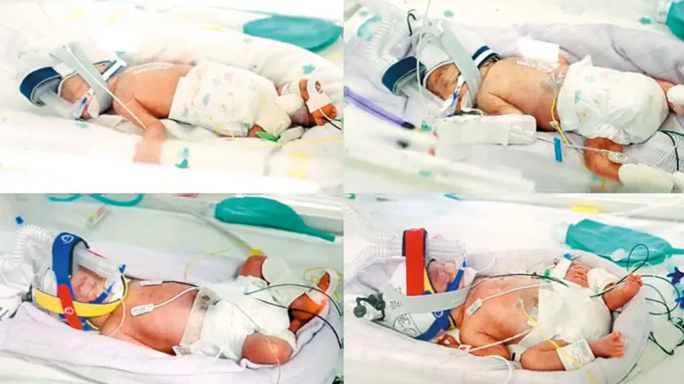 Avustralya'da mucize doğum: 15 milyonda bir görülen tek yumurta dördüzleri görseli