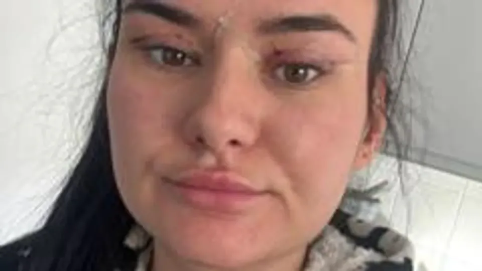 Göz Kapağı Ameliyatı Turizmi: Ucuzun Bedeli Ağır Geçiyor görseli